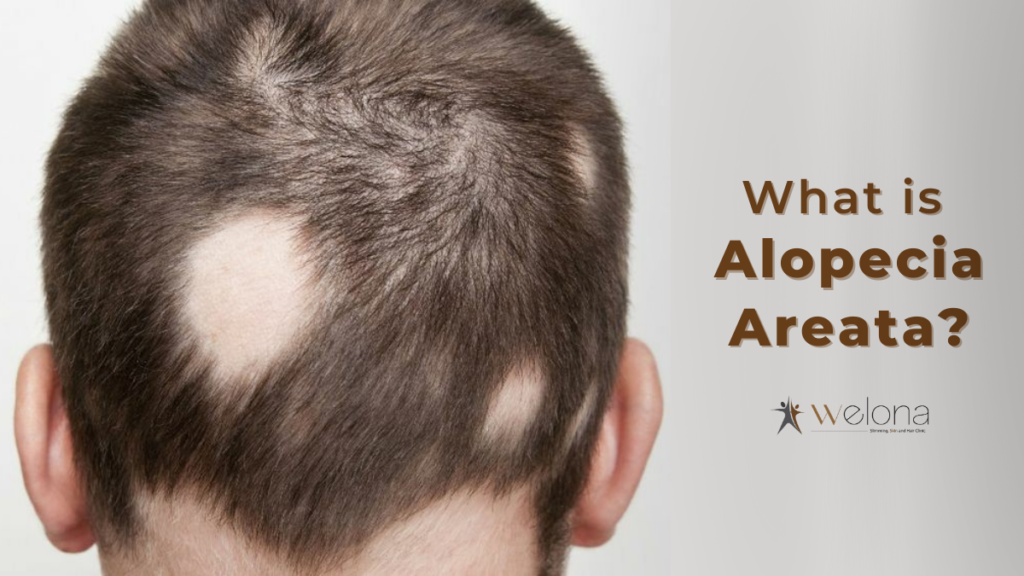 Alopecia Areata and its cure