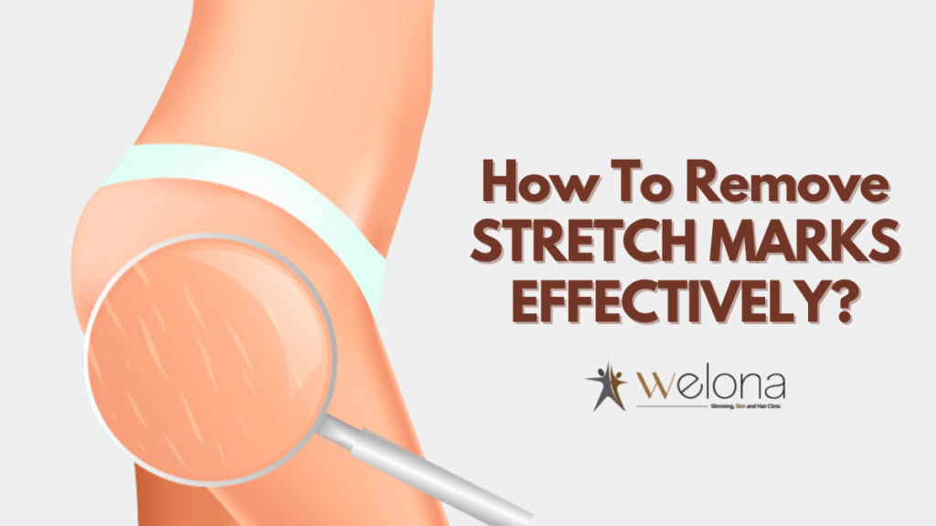 Stretch marks treatment
