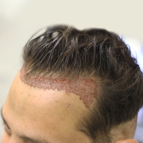 How successful is FUE hair transplant?