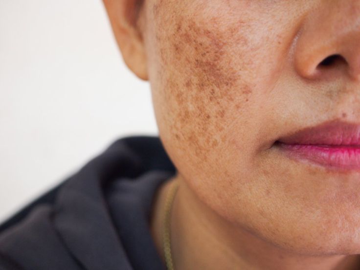 Addressing Hyperpigmentation: Causes and Solutions