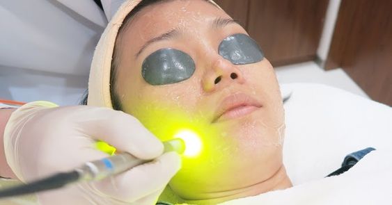 Benefits of Q-SWITCH Laser treatment for Pigmentation Reduction