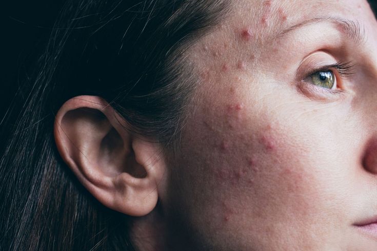 Tips to Deal with Acne-prone Skin