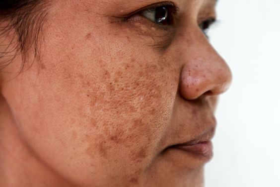 How to Combat Hyperpigmentation in the Right Way!
