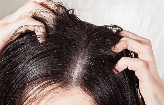 Understanding and Dealing with Dandruff