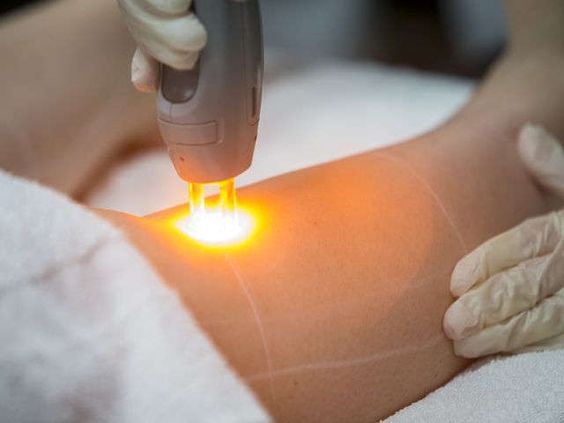 Benefits of Q-SWITCH Laser treatment for Pigmentation Reduction