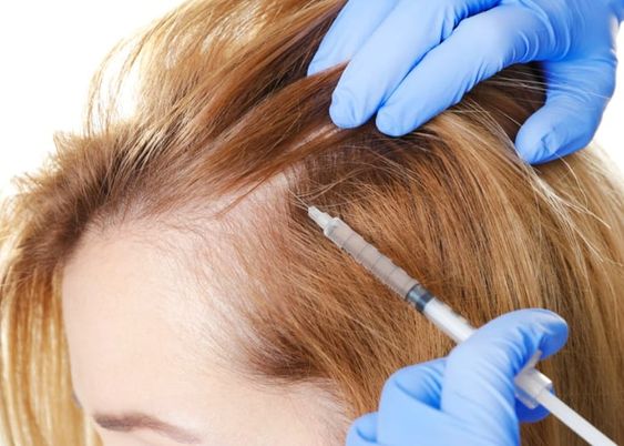 The Success Rate of PRP Treatment for Hair
